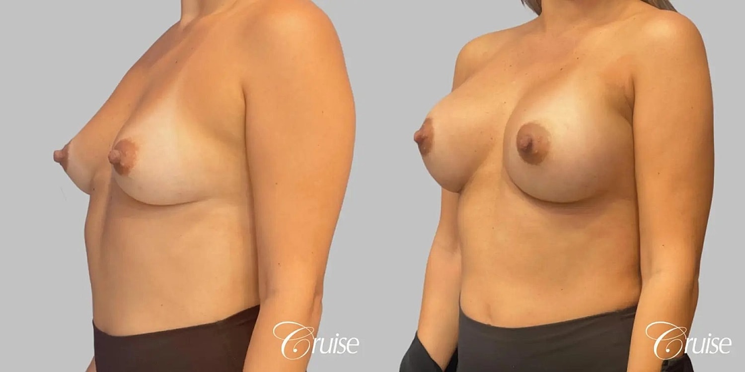 Breast Augmentation Before & After
