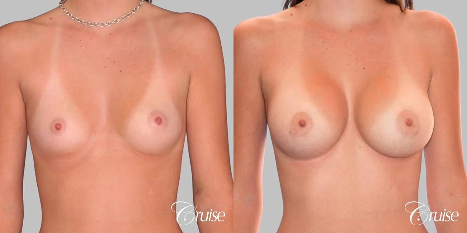 Breast Augmentation Before & After