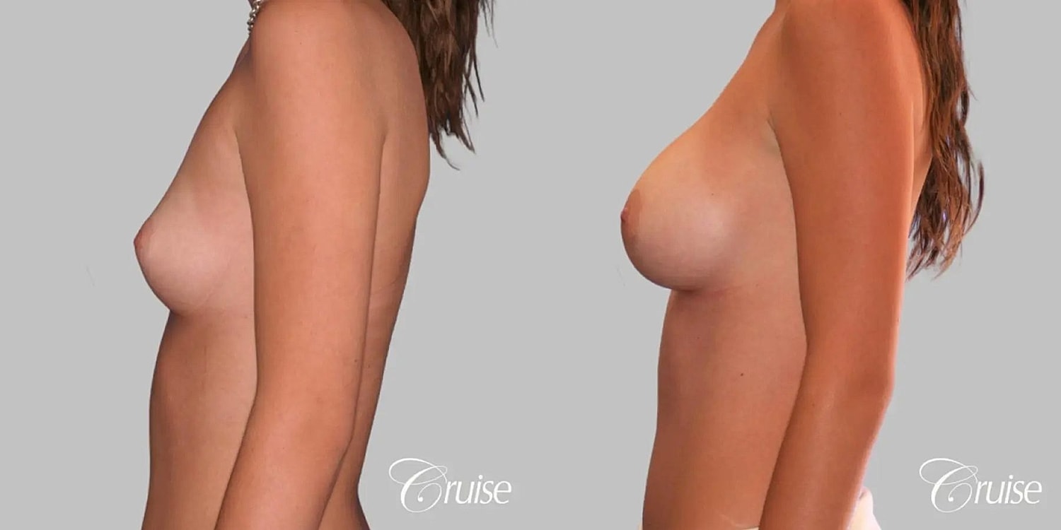 Breast Augmentation Before & After