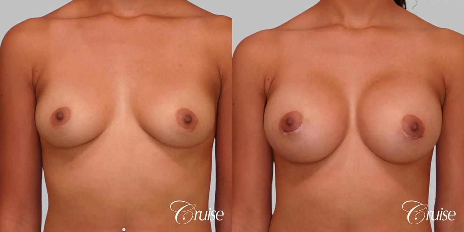 Breast Augmentation Before & After