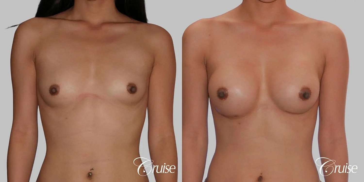 Breast Augmentation Before & After