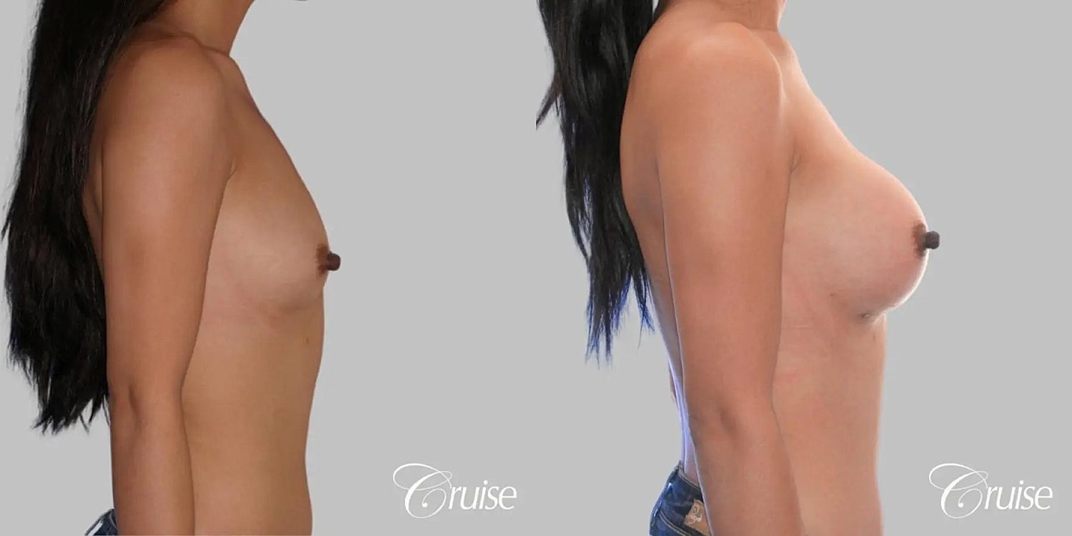 Breast Augmentation Before & After