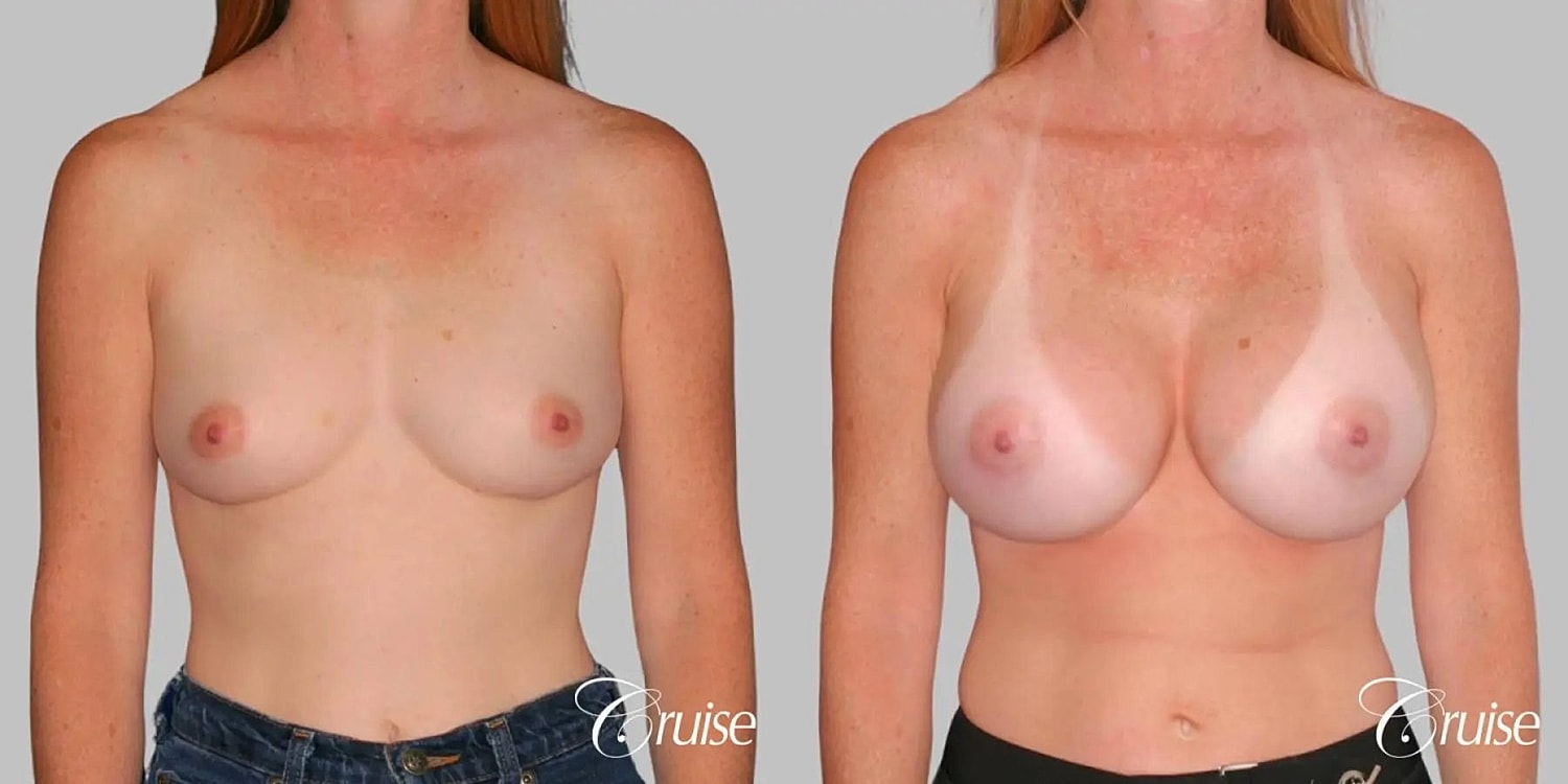Breast Augmentation Before & After