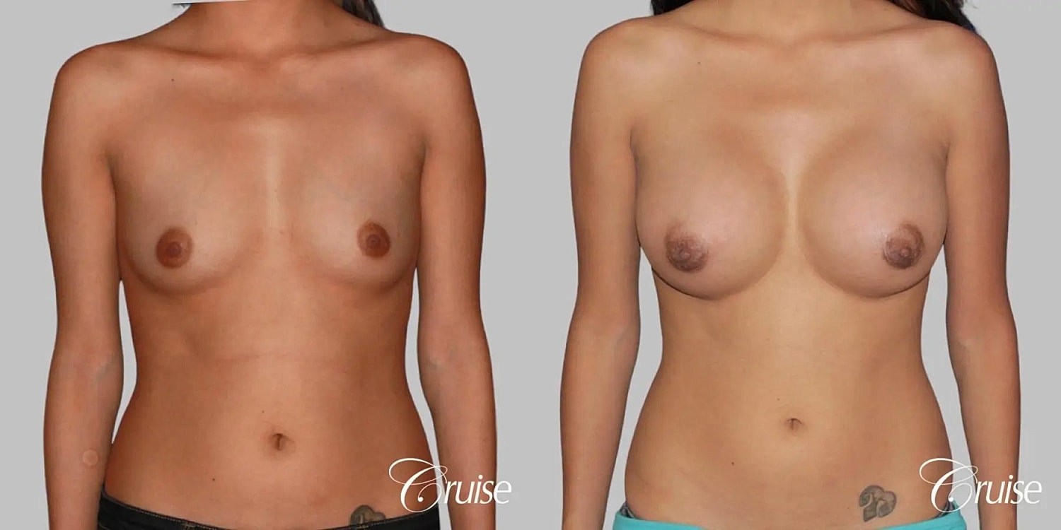 Breast Augmentation Before & After