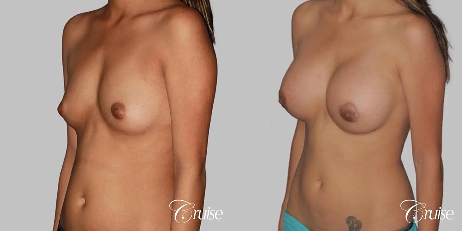 Breast Augmentation Before & After