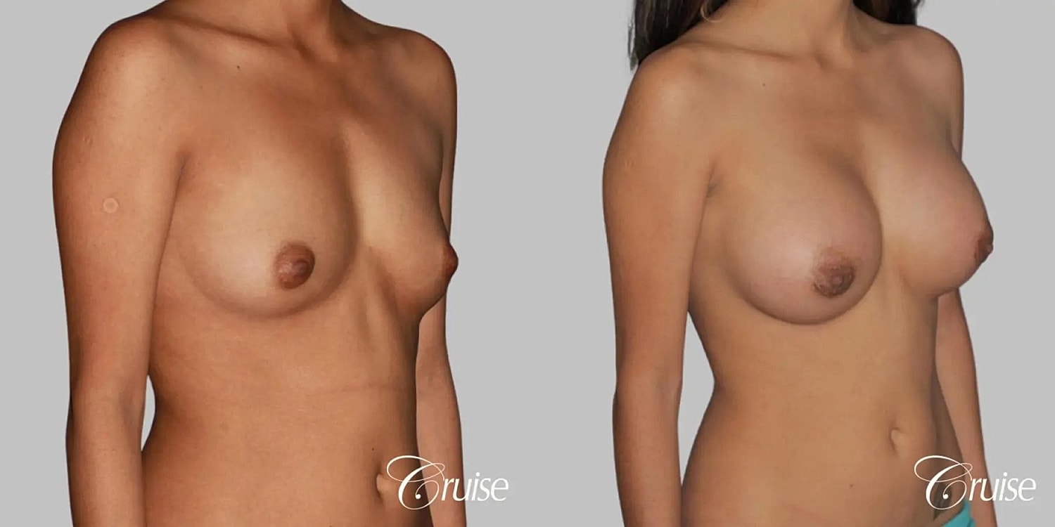 Breast Augmentation Before & After
