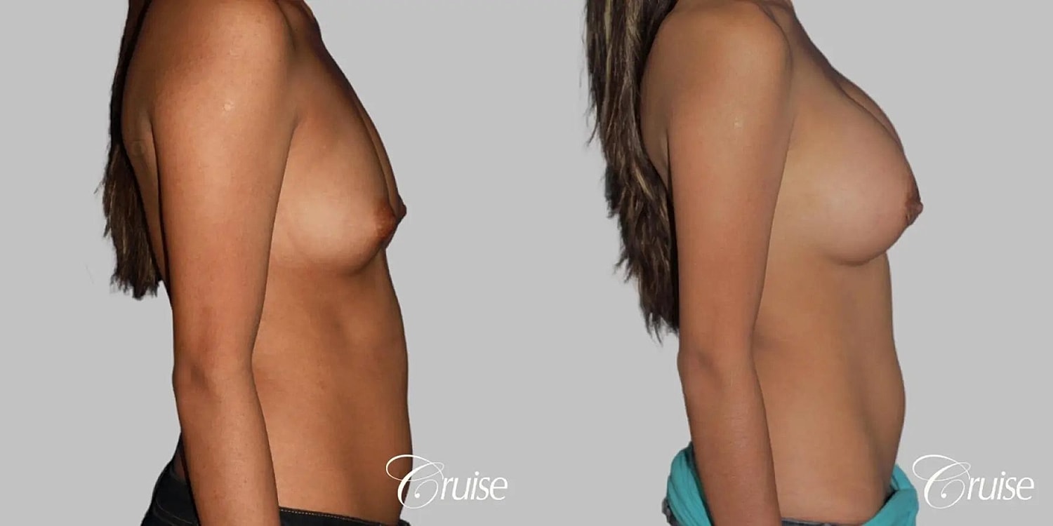 Breast Augmentation Before & After