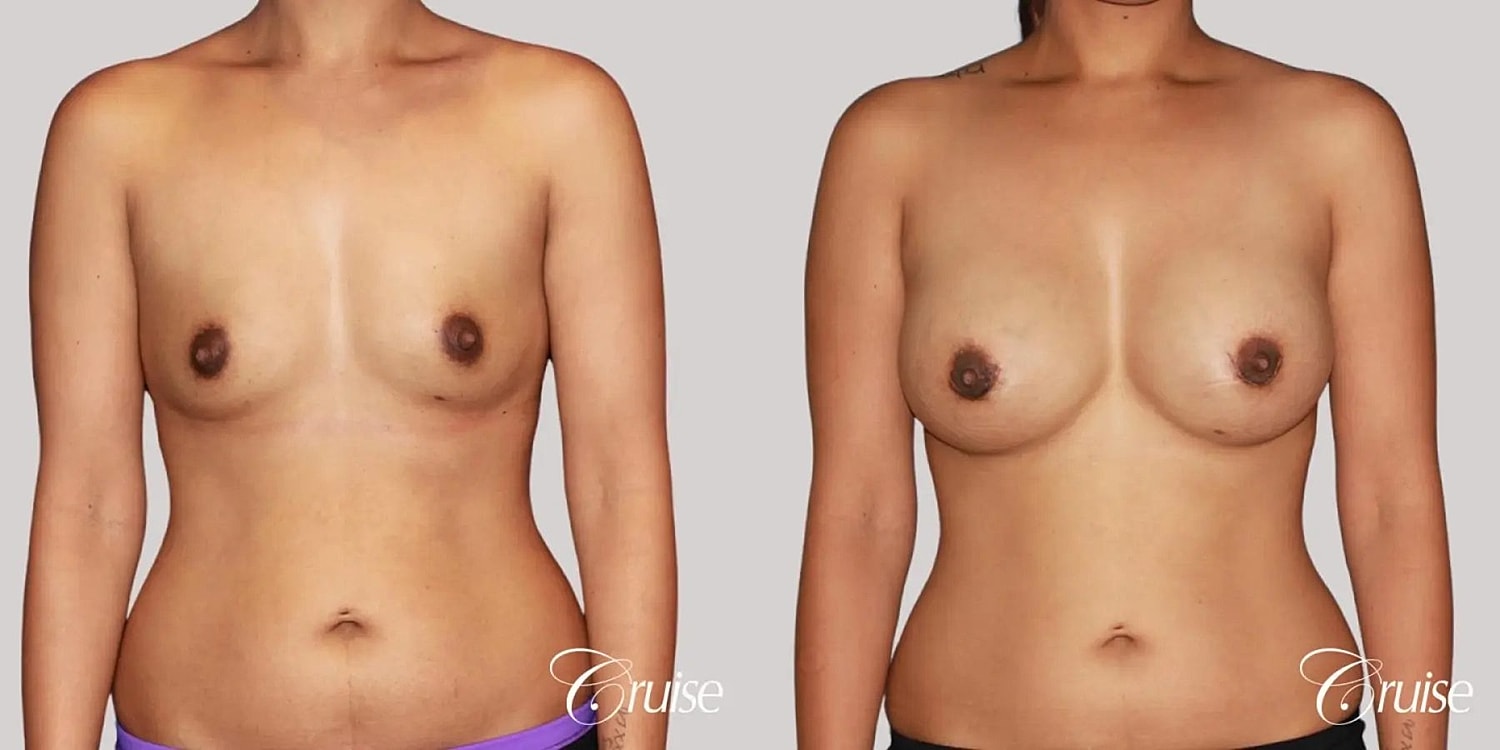 Breast Augmentation Before & After