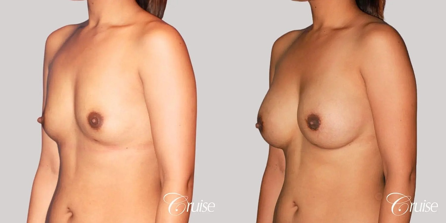 Breast Augmentation Before & After