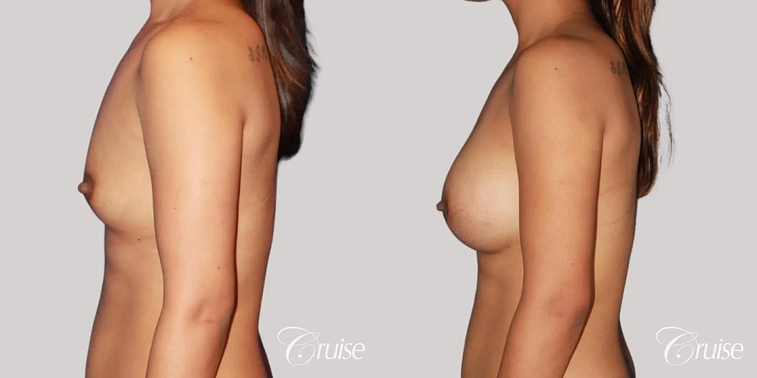Breast Augmentation Before & After