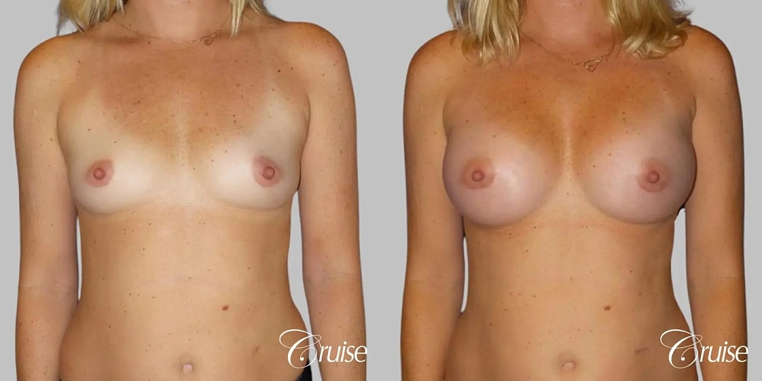 Breast Augmentation Before & After