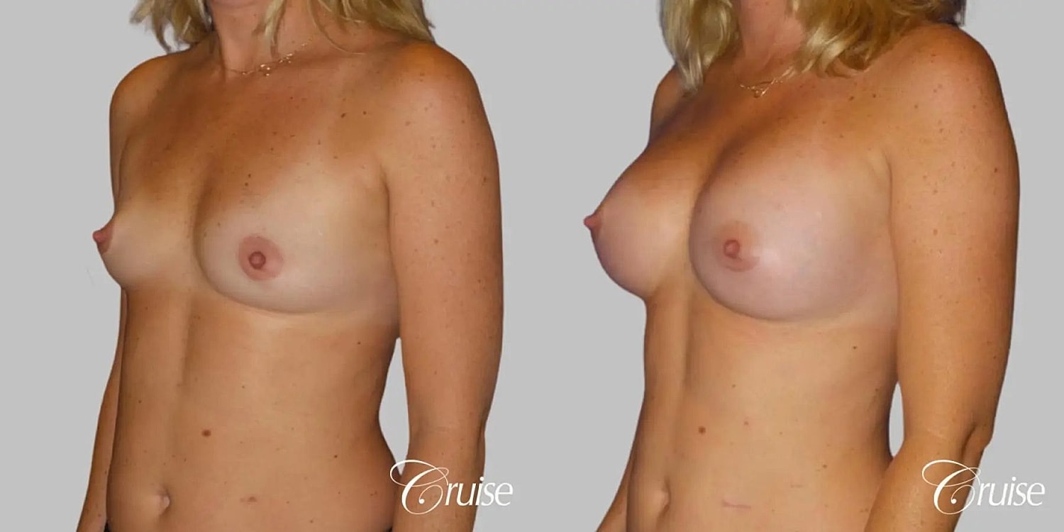 Breast Augmentation Before & After