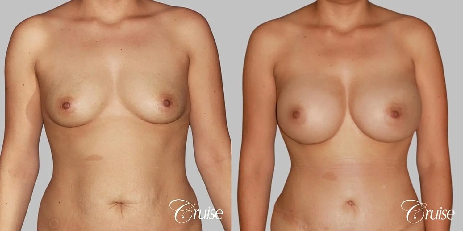 Breast Augmentation Before & After