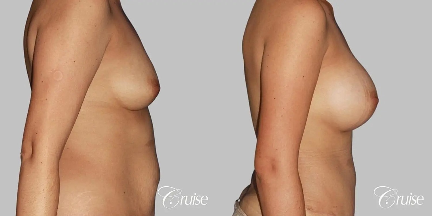 Breast Augmentation Before & After