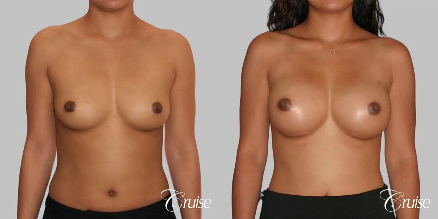 Breast Augmentation Before & After