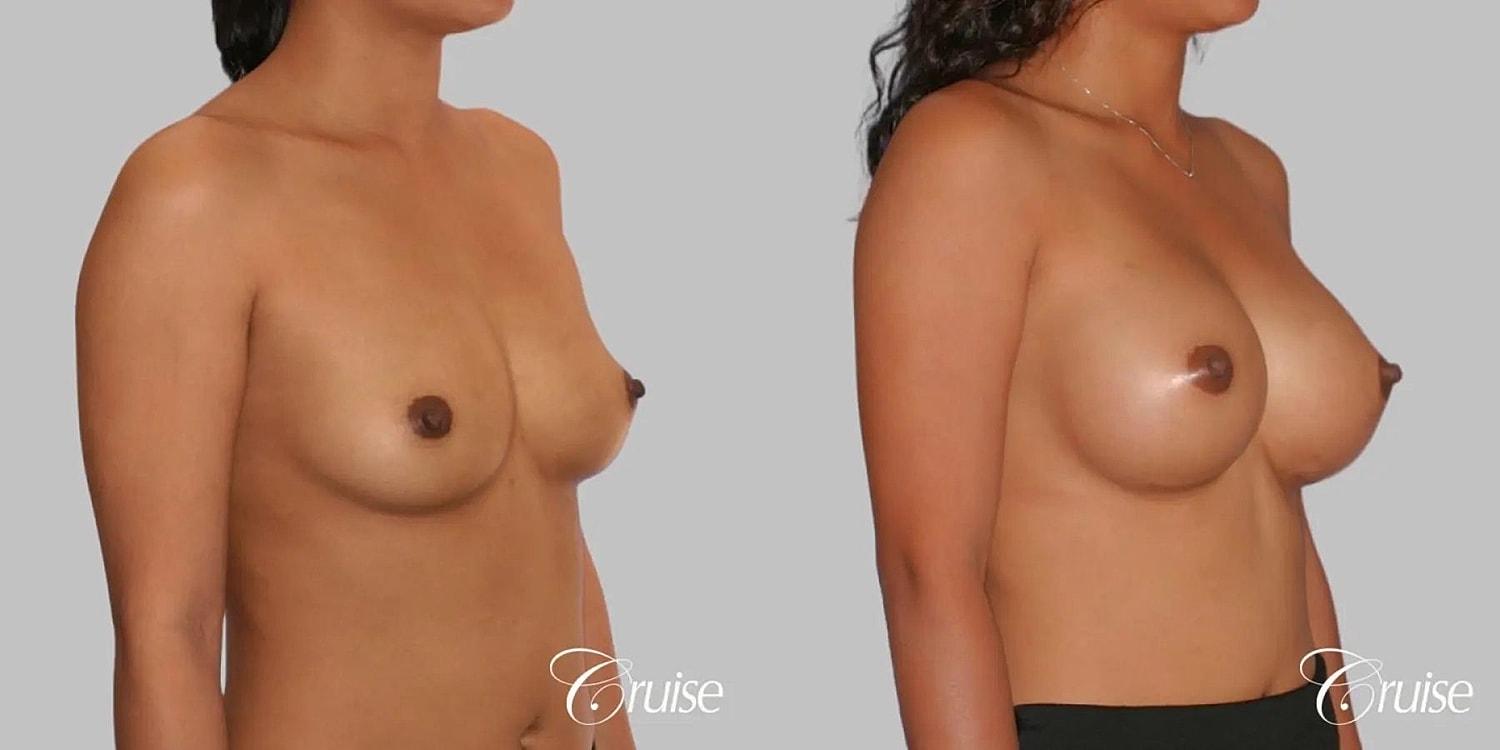 Breast Augmentation Before & After