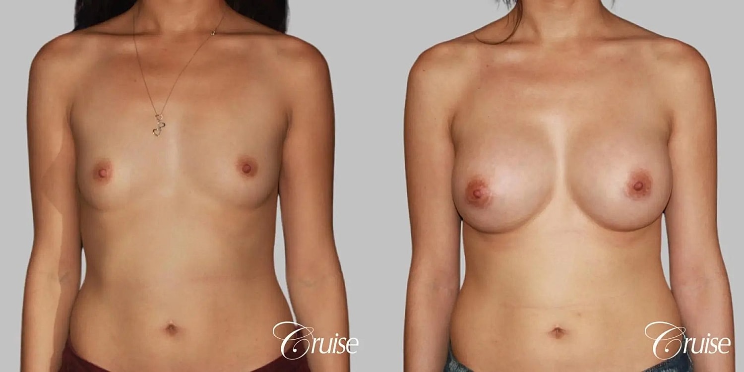 Breast Augmentation Before & After
