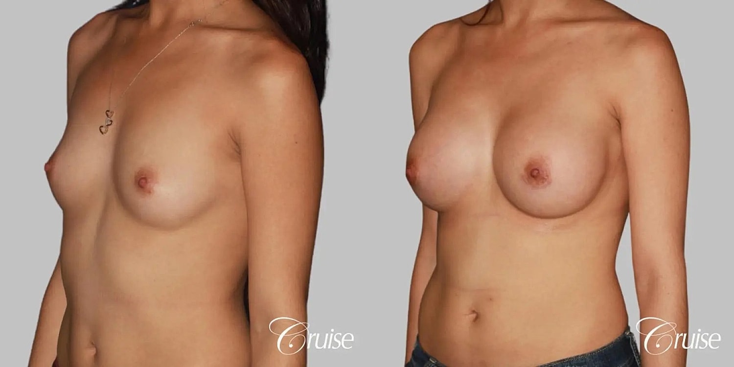 Breast Augmentation Before & After