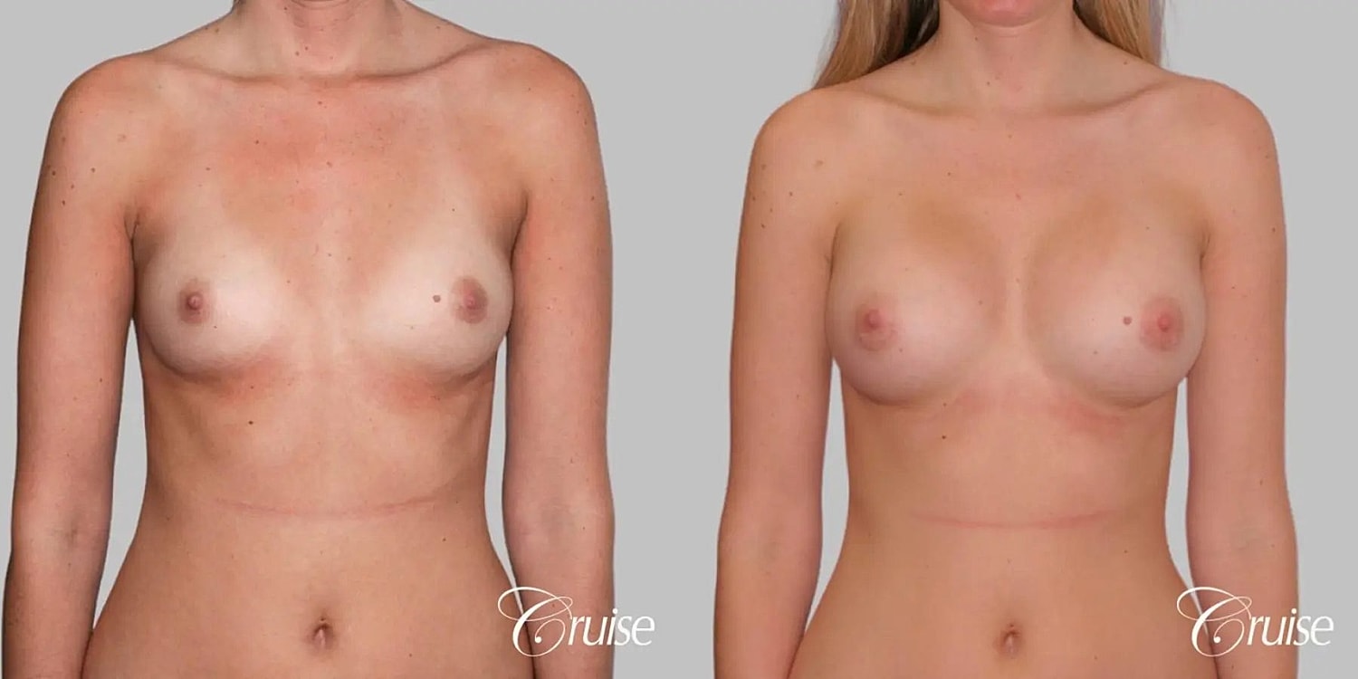 Breast Augmentation Before & After