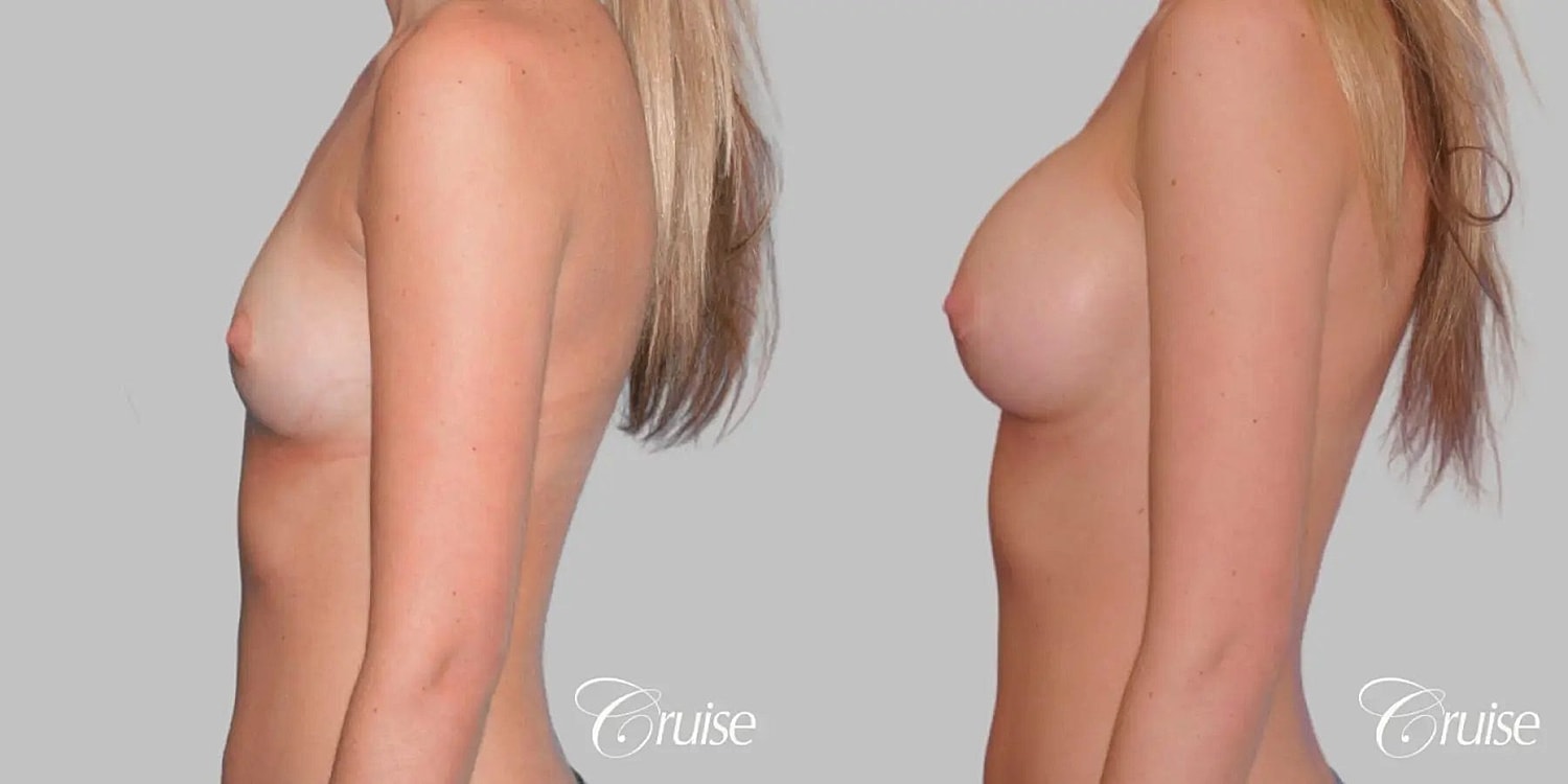Breast Augmentation Before & After