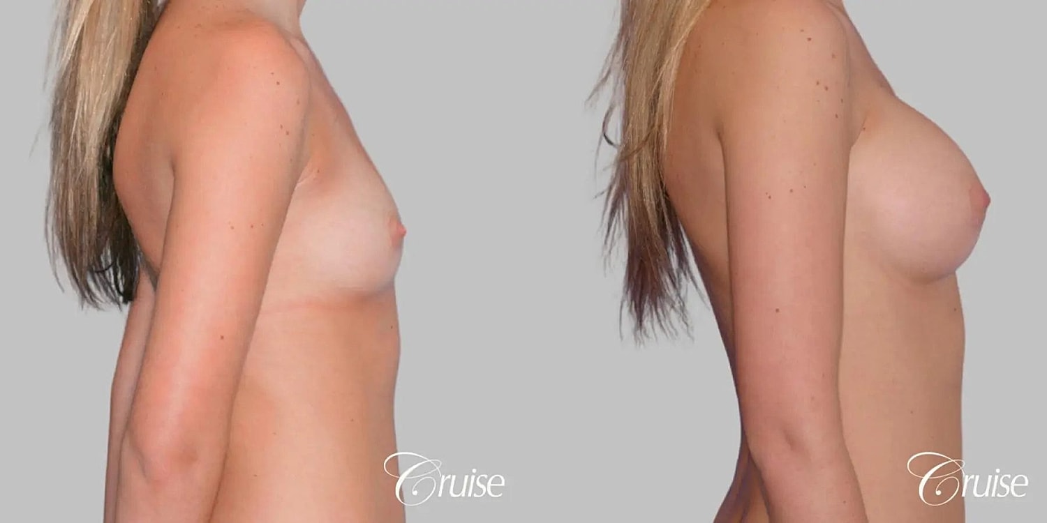 Breast Augmentation Before & After