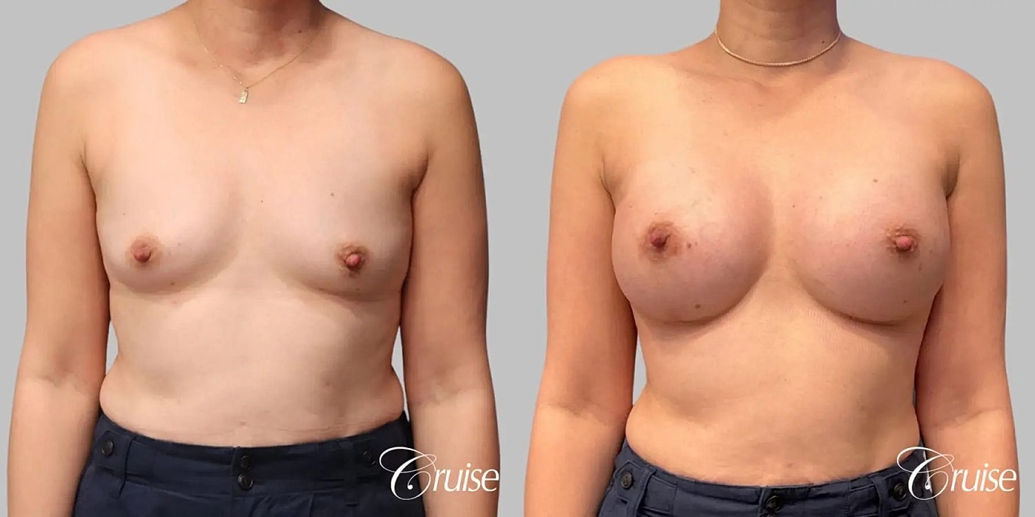 Breast Augmentation Before & After