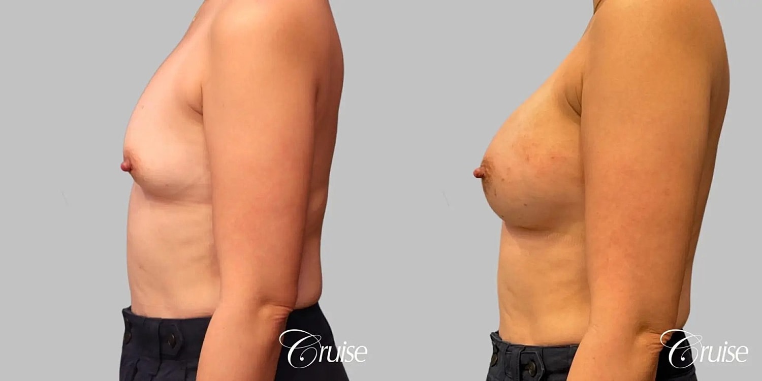 Breast Augmentation Before & After