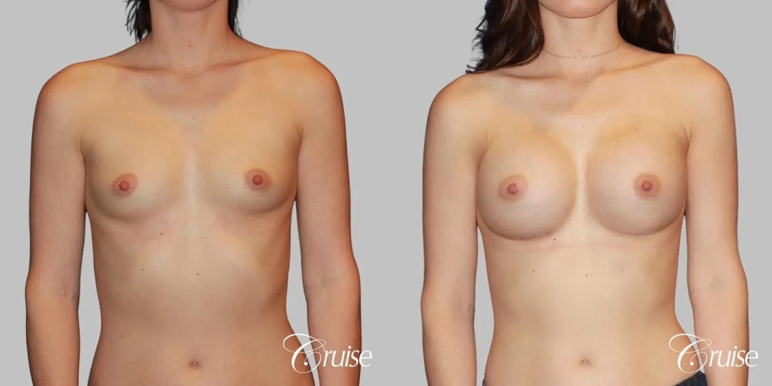 Breast Augmentation Before & After