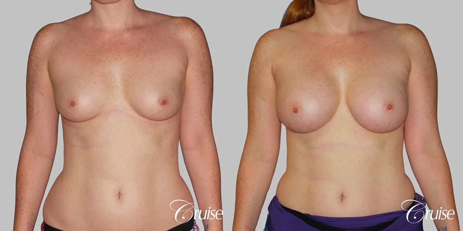 Breast Augmentation Before & After