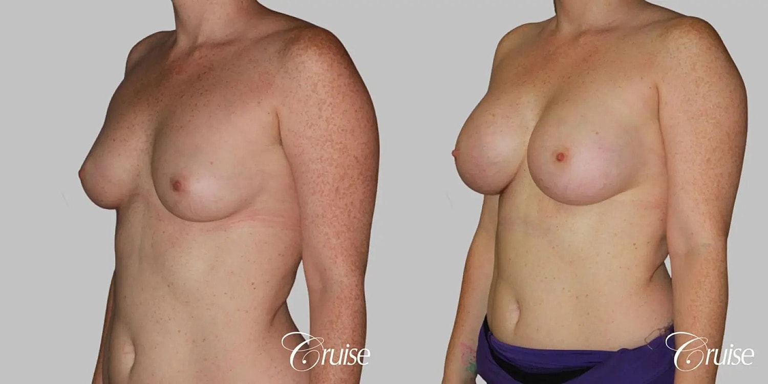 Breast Augmentation Before & After
