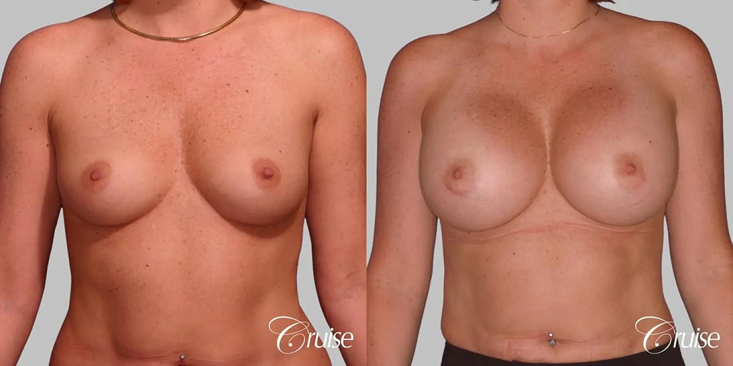 Breast Augmentation Before & After