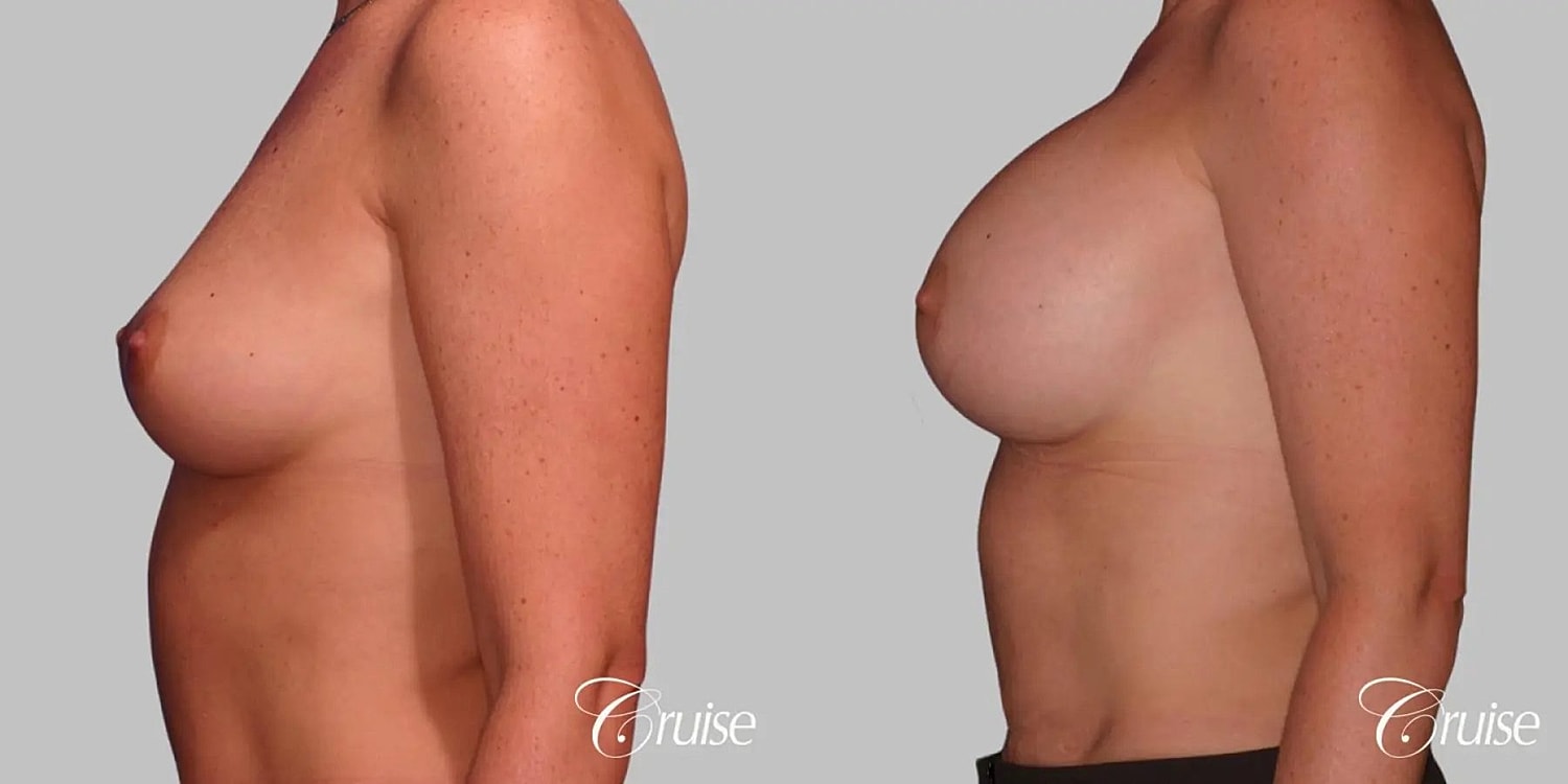 Breast Augmentation Before & After
