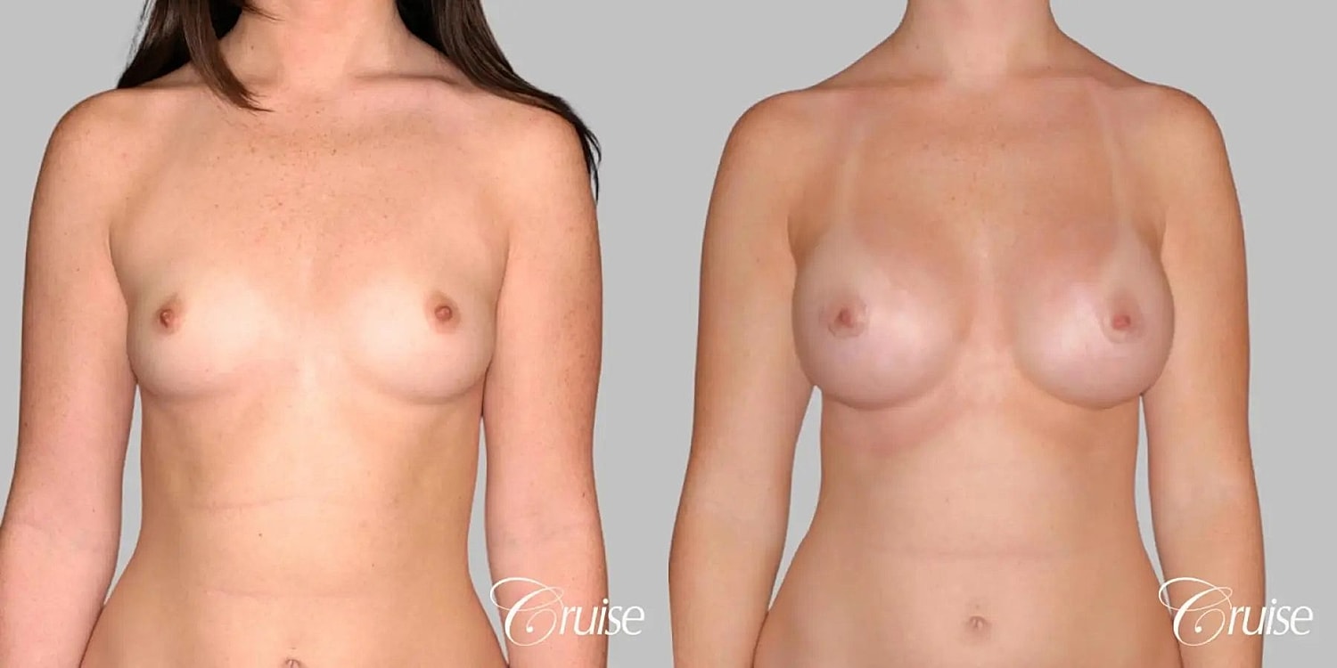Breast Augmentation Before & After