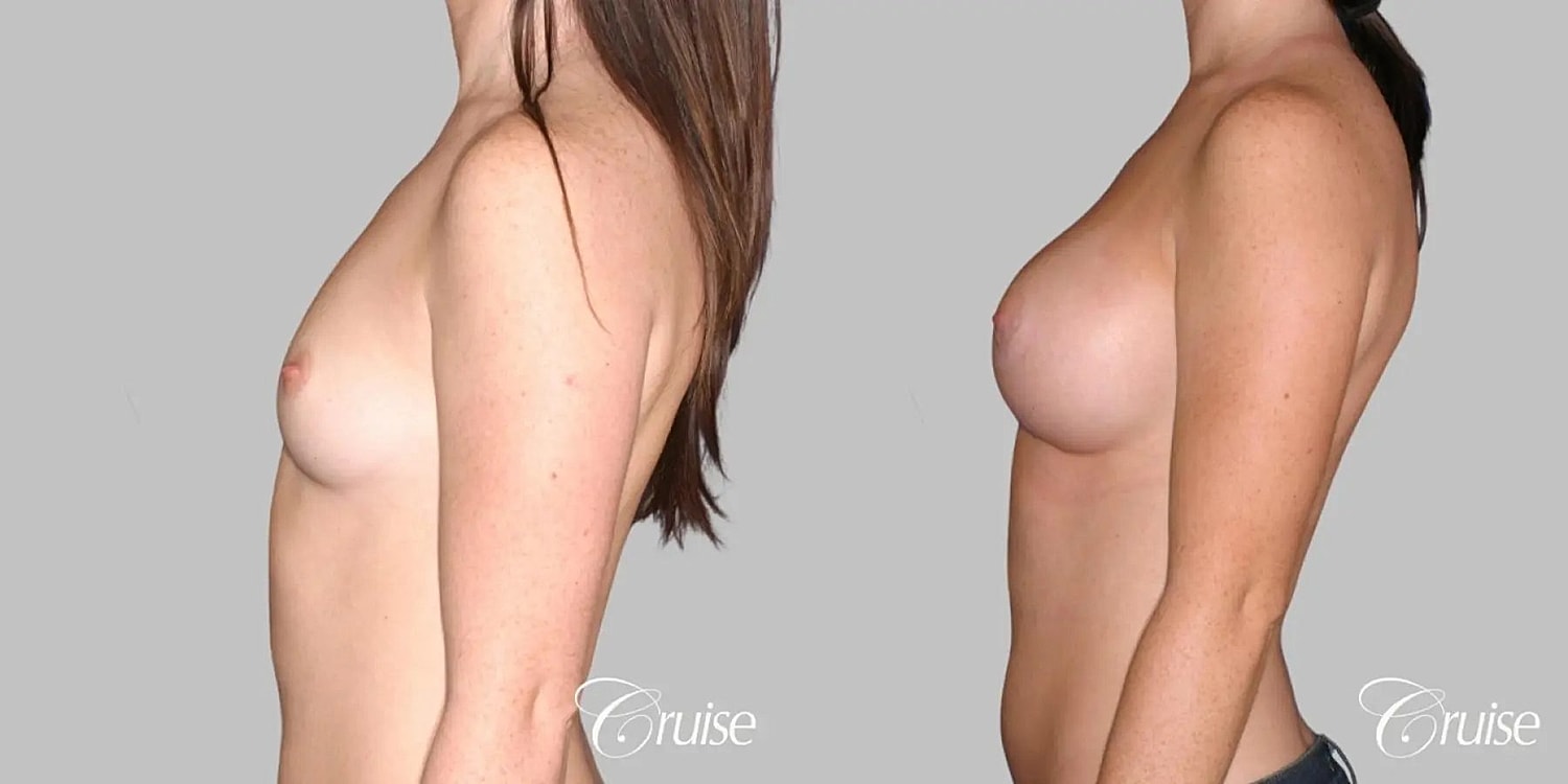 Breast Augmentation Before & After