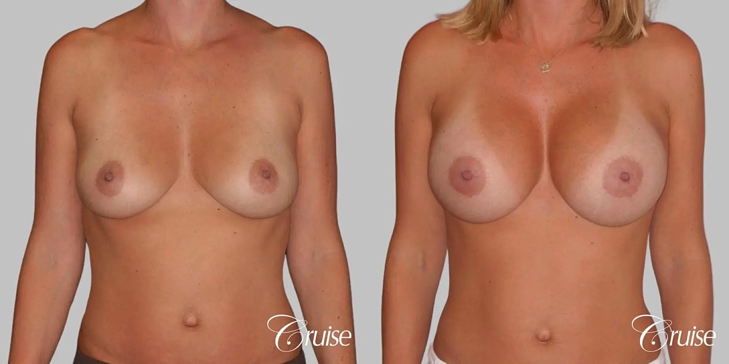 Breast Augmentation Before & After