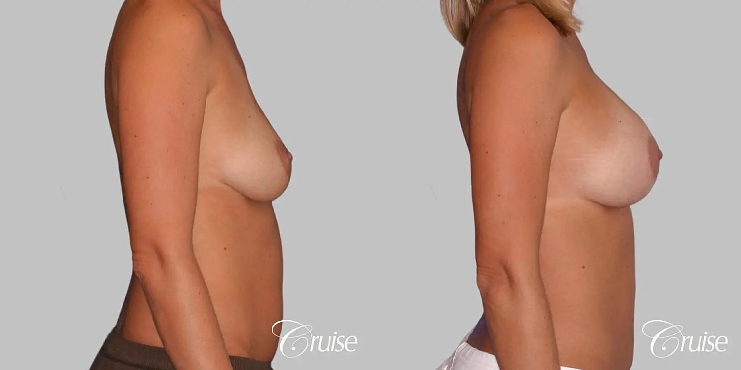 Breast Augmentation Before & After