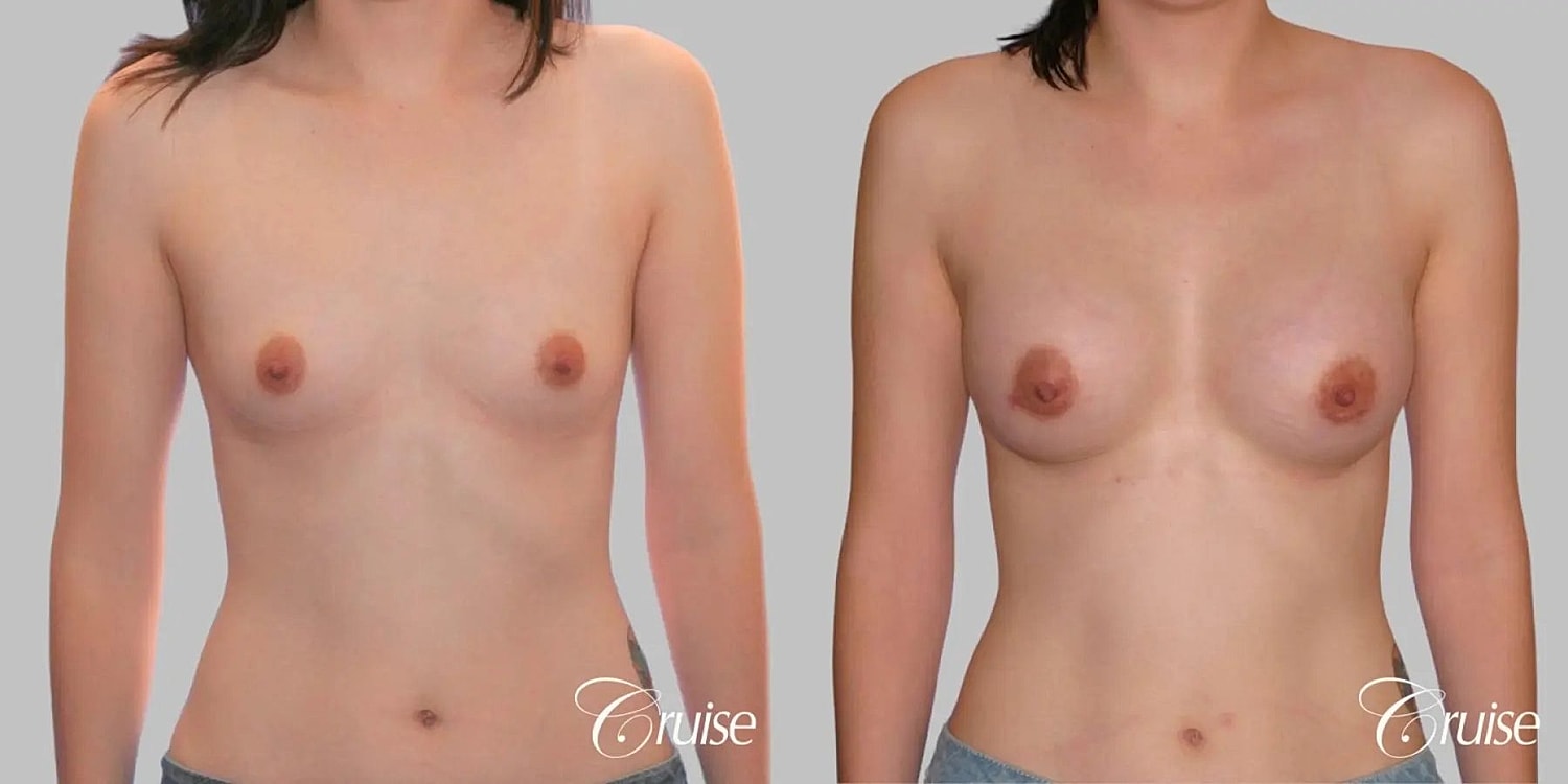 Breast Augmentation Before & After