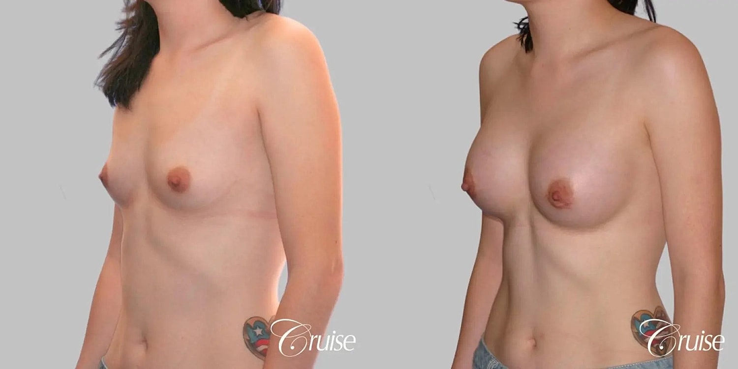 Breast Augmentation Before & After