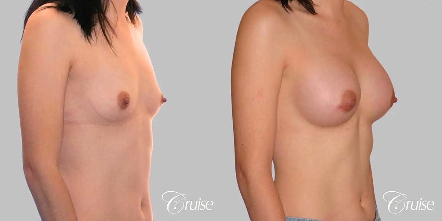 Breast Augmentation Before & After