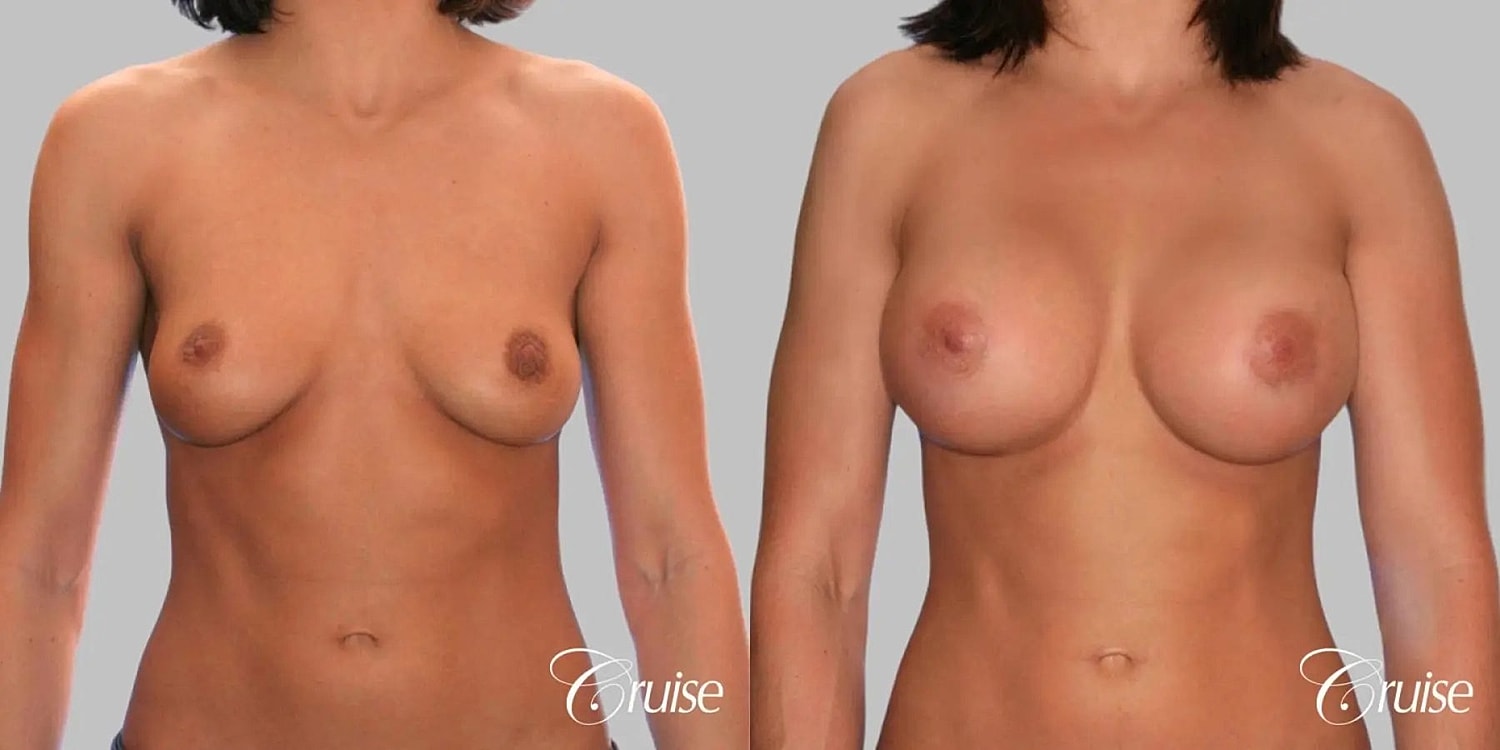 Breast Augmentation Before & After