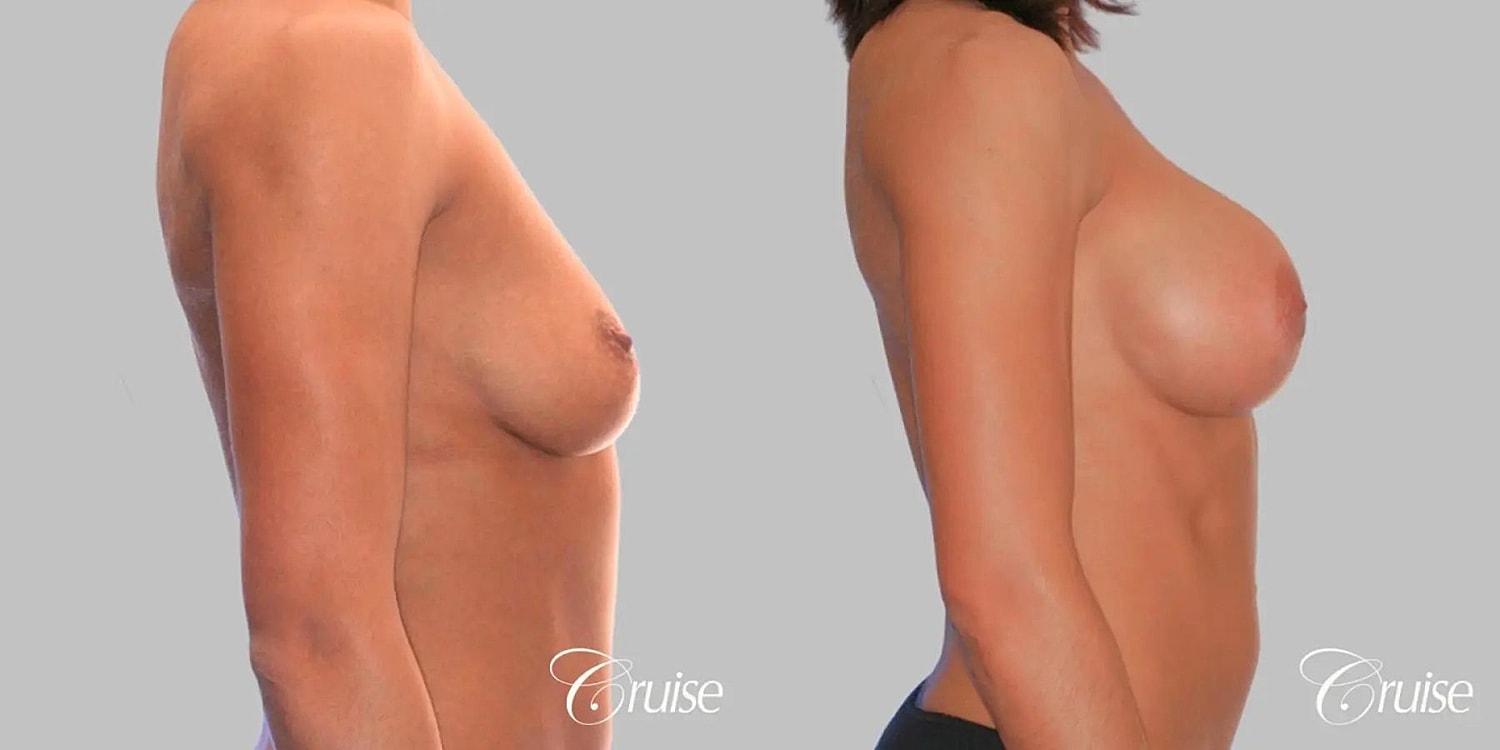 Breast Augmentation Before & After