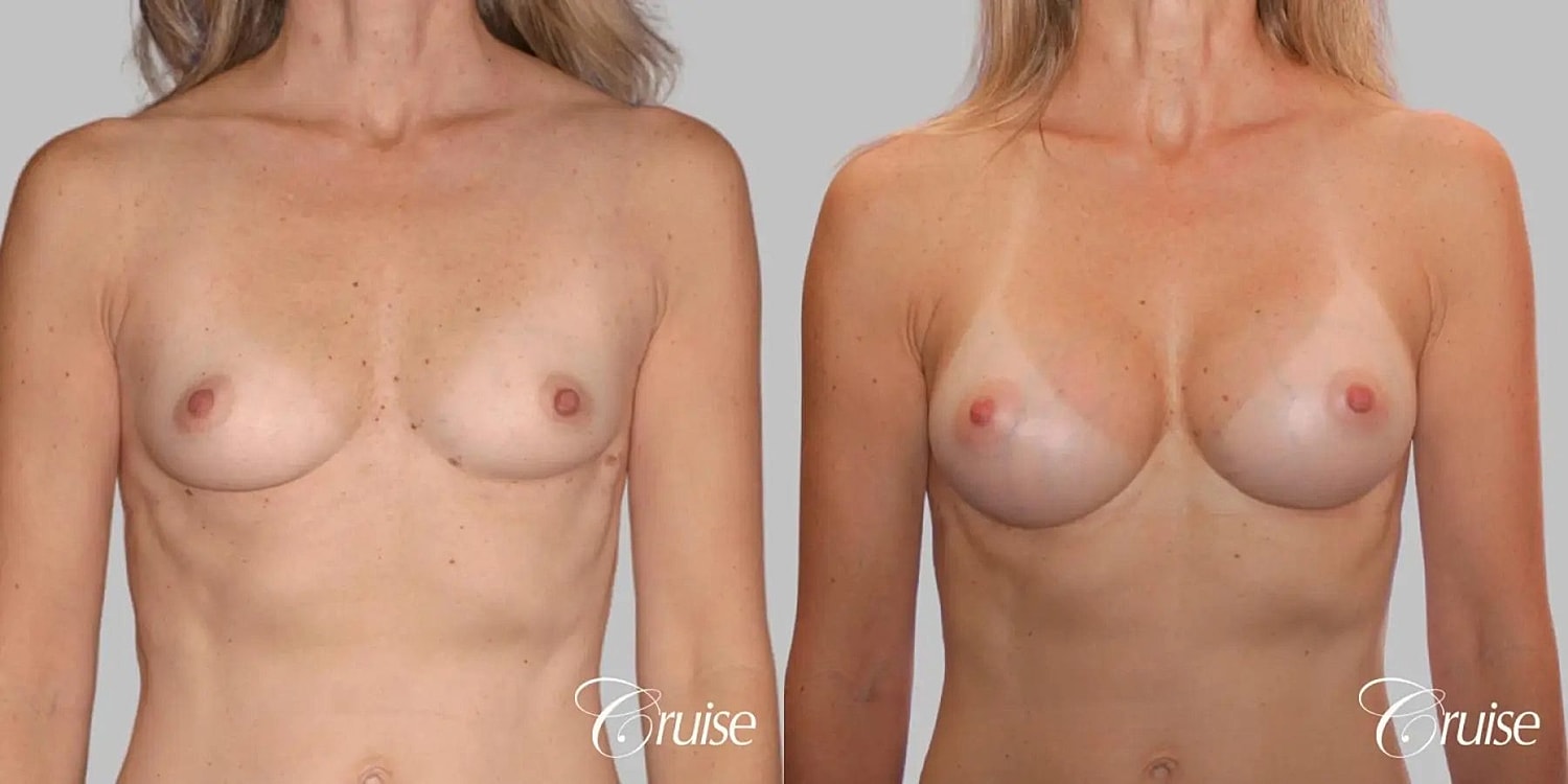 Breast Augmentation Before & After