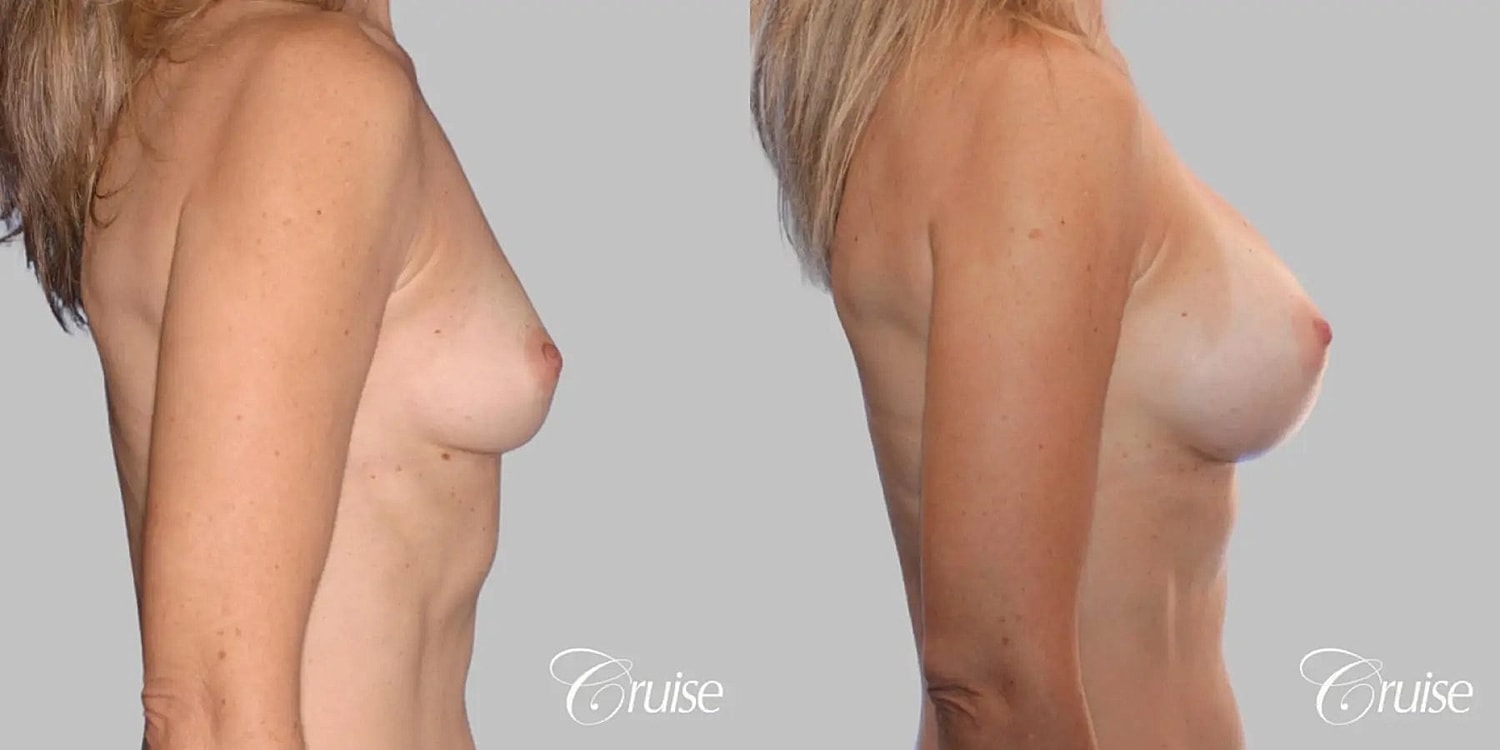 Breast Augmentation Before & After