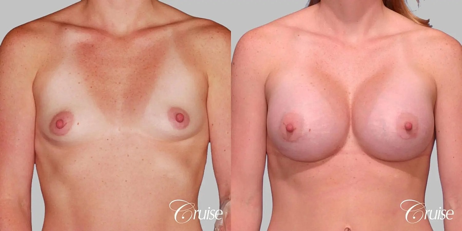 Breast Augmentation Before & After