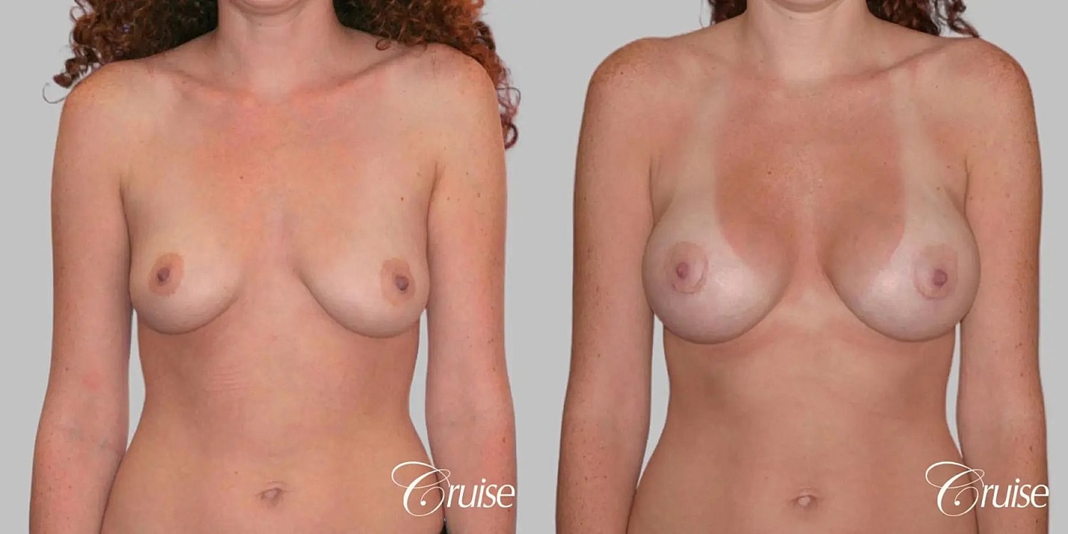 Breast Augmentation Before & After