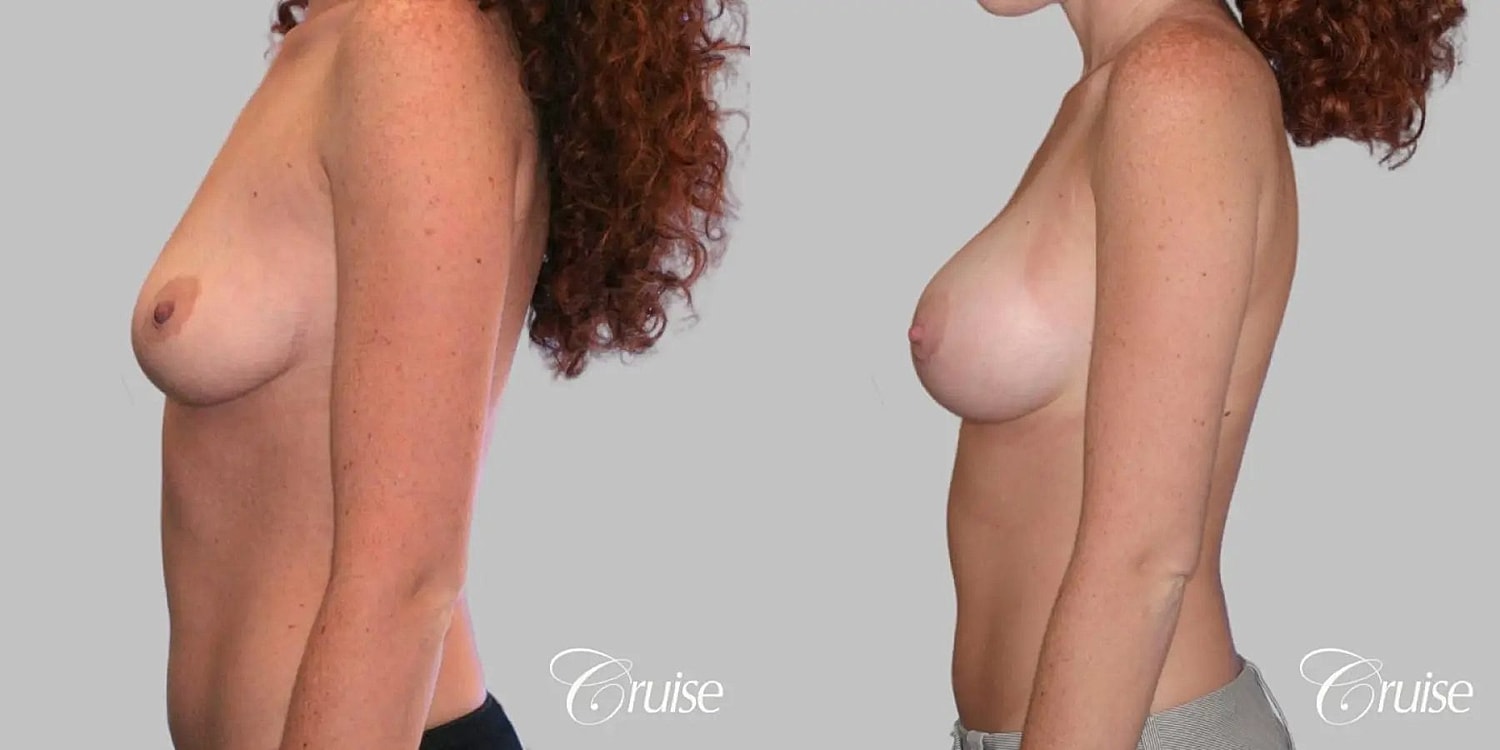 Breast Augmentation Before & After