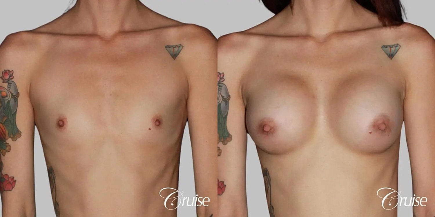 Breast Augmentation Before & After