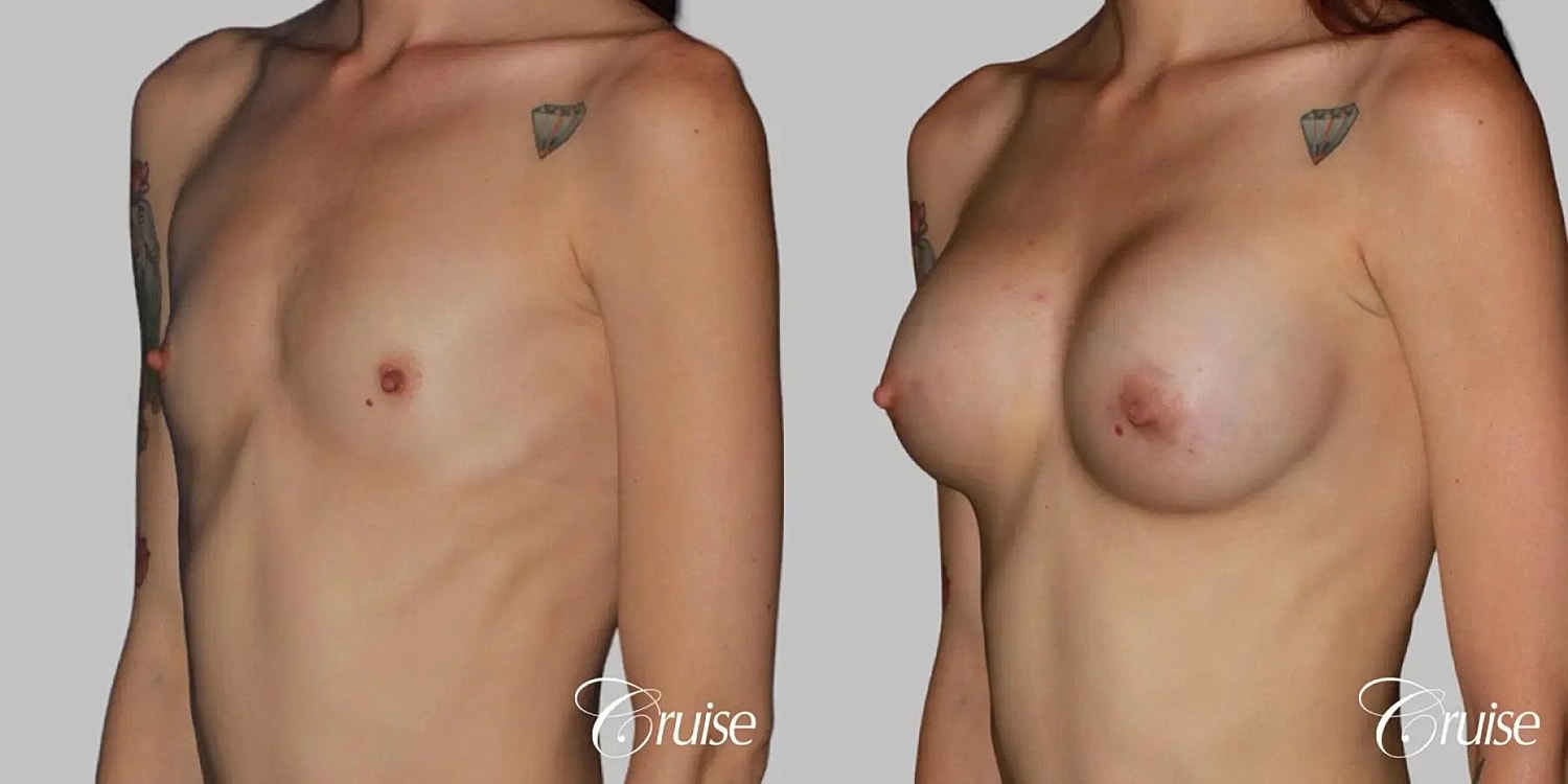 Breast Augmentation Before & After