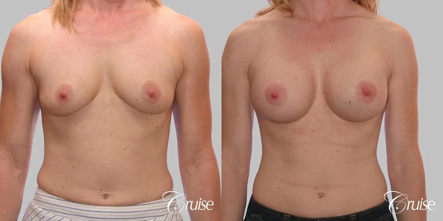Breast Augmentation Before & After