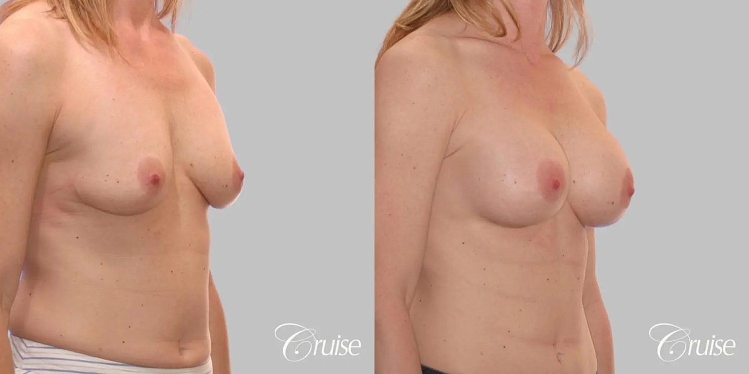Breast Augmentation Before & After